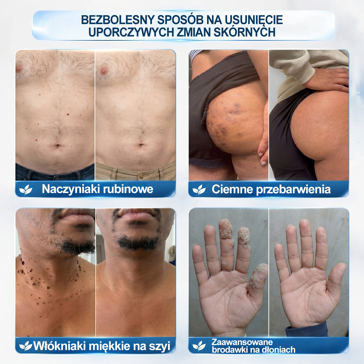 Oficjalny Sklep Markowy | ✅👩‍⚕️ 𝐏i𝐜𝐝o® 7-Dniowy 𝗧𝗮𝗴 & 𝗦𝗽𝗼𝐭 𝐄𝐫𝐚𝐬𝐞𝐫 (Bez bólu, Bez blizn – aplikator z kulką)💘
