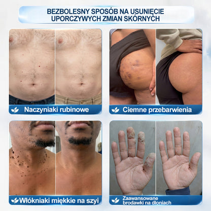 Oficjalny Sklep Markowy | ✅👩‍⚕️ 𝐏i𝐜𝐝o® 7-Dniowy 𝗧𝗮𝗴 & 𝗦𝗽𝗼𝐭 𝐄𝐫𝐚𝐬𝐞𝐫 (Bez bólu, Bez blizn – aplikator z kulką)💘