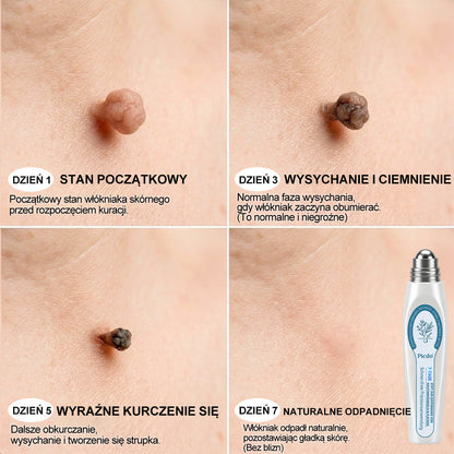 Oficjalny Sklep Markowy | ✅👩‍⚕️ 𝐏i𝐜𝐝o® 7-Dniowy 𝗧𝗮𝗴 & 𝗦𝗽𝗼𝐭 𝐄𝐫𝐚𝐬𝐞𝐫 (Bez bólu, Bez blizn – aplikator z kulką)💘
